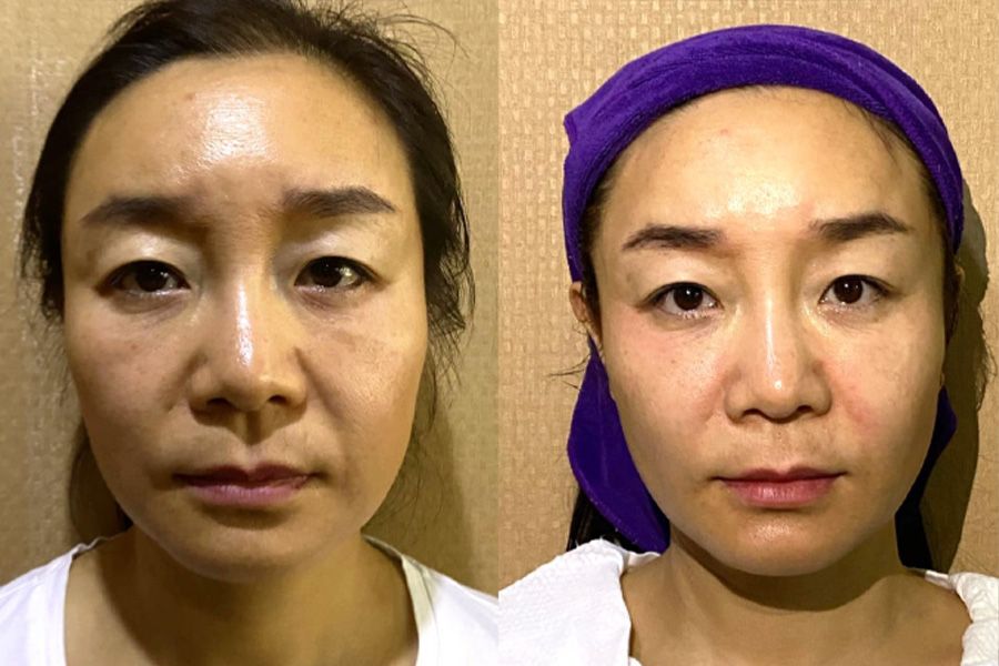 소프웨이브 시술 1주 경과 전후