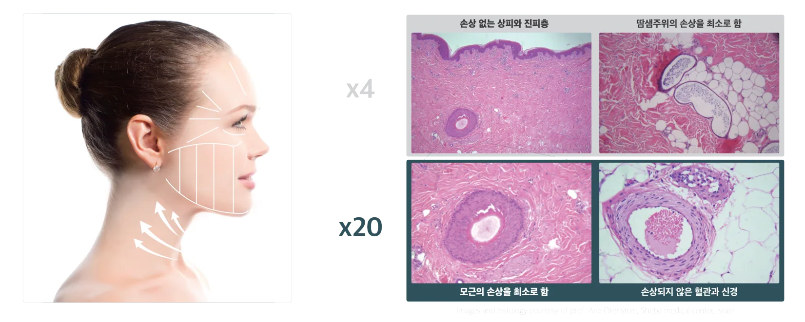 튠페이스의 콜라겐 재생 원리