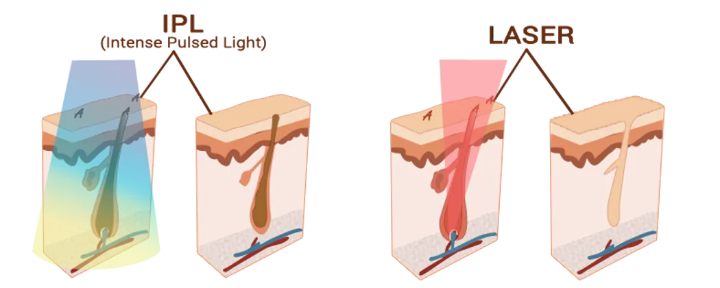 기존 IPL과의 차이점